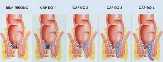 phân loại bệnh trĩ dựa theo cấp độ