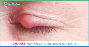 Lẹo mắt: Nguyên nhân, triệu chứng và cách điều trị