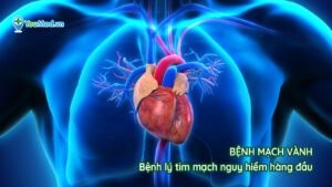 Bệnh mạch vành: Bệnh lý tim mạch nguy hiểm hàng đầu