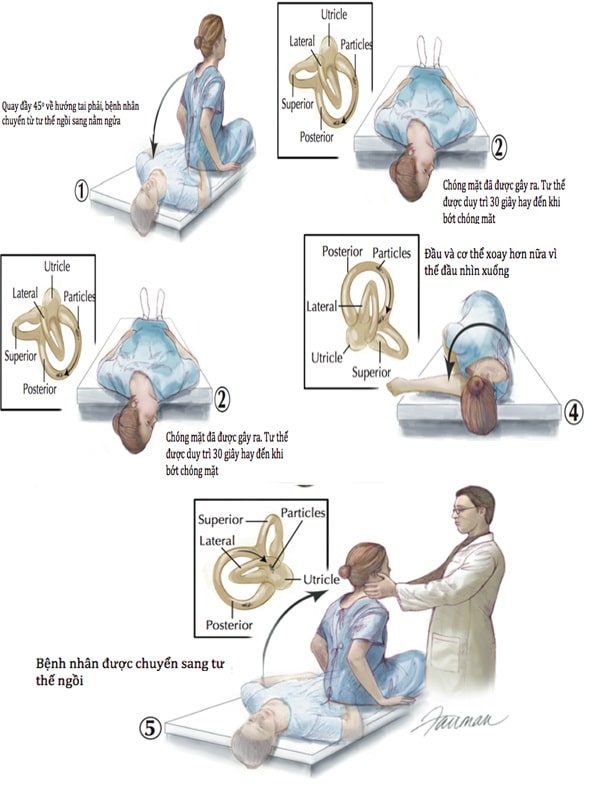 Nghiệm pháp Epley trong điều trị chóng mặt tư thế kịch phát lành tính