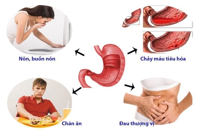 Triệu chứng tiêu hóa cần nội soi dạ dày