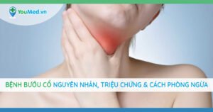 Bệnh bướu cổ: Nguyên nhân, triệu chứng và cách điều trị