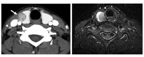 MRRI và CT scan tuyến giáp