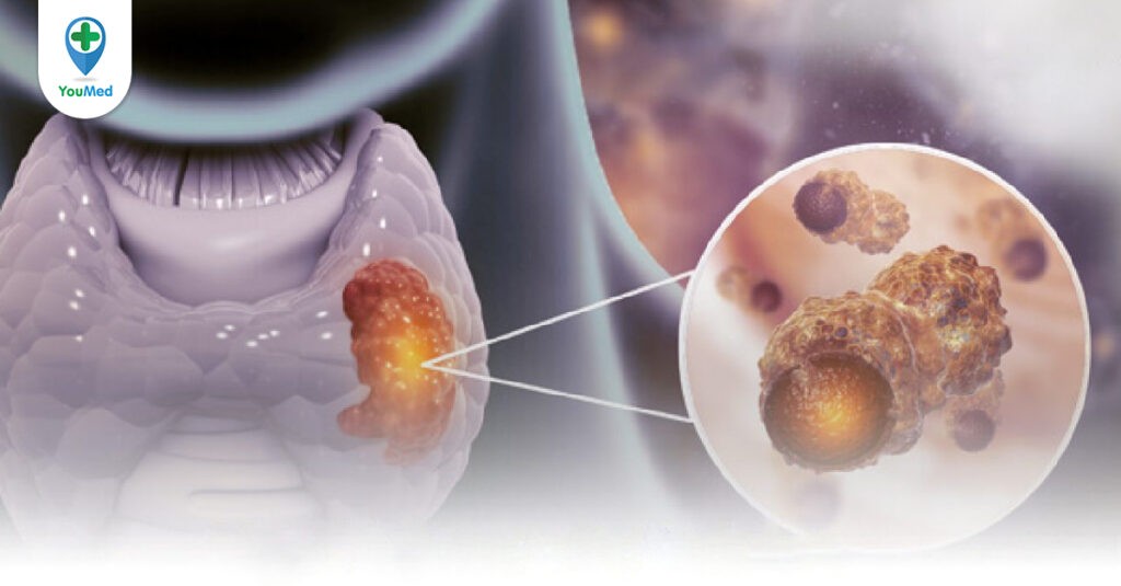 Ung thư tuyến giáp: dấu hiệu, nguyên nhân và tiên lượng bệnh