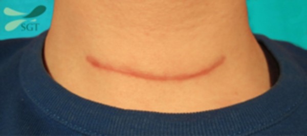 Sẹo vùng cổ sau mổ cắt tuyến giáp
