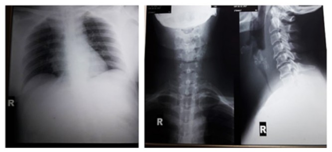 Phim Xquang ngực thẳng và X - quang cổ thẳng và nghiêng trên bệnh nhân ung thư giáp dạng nhú