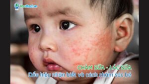 Chàm sữa: Dấu hiệu nhận biết và cách chăm sóc bé