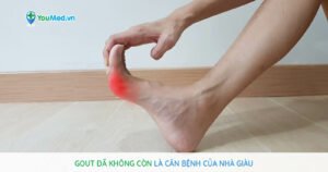 Gout: Đã không còn là căn bệnh của người giàu!