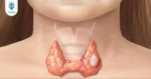 Giải đáp những thắc mắc thường gặp về bệnh cường giáp