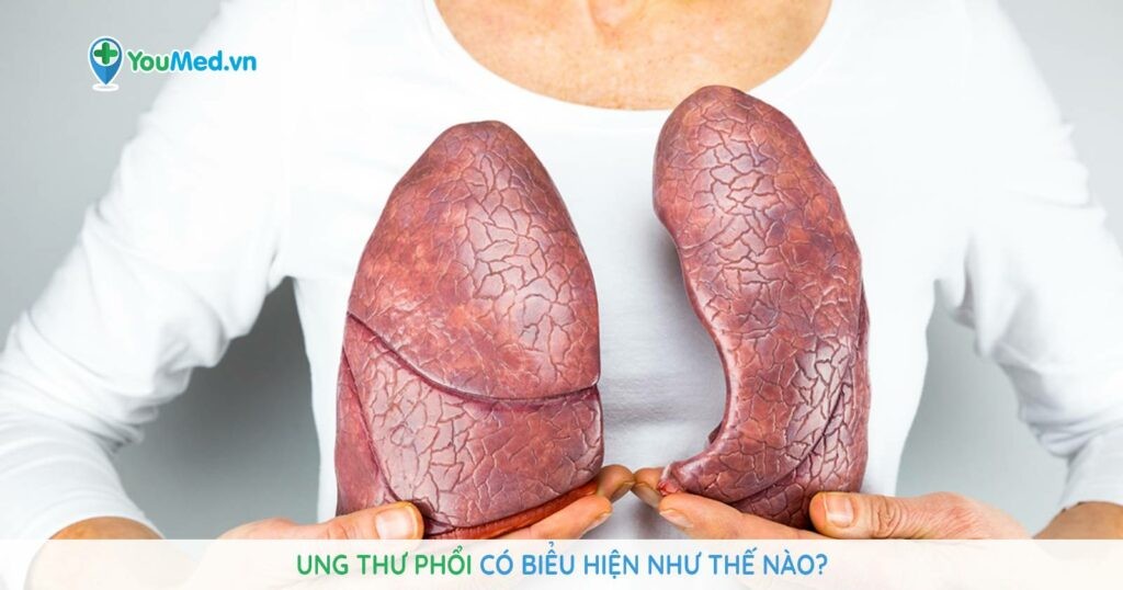 Ung thư phổi có biểu hiện thế nào?