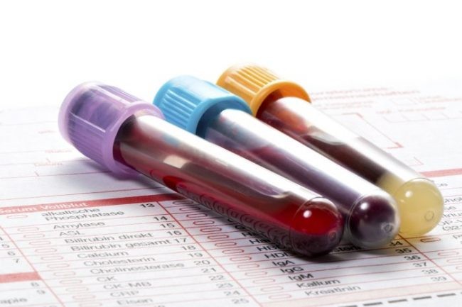 10 chỉ số xét nghiệm máu quan trọng bạn cần biết