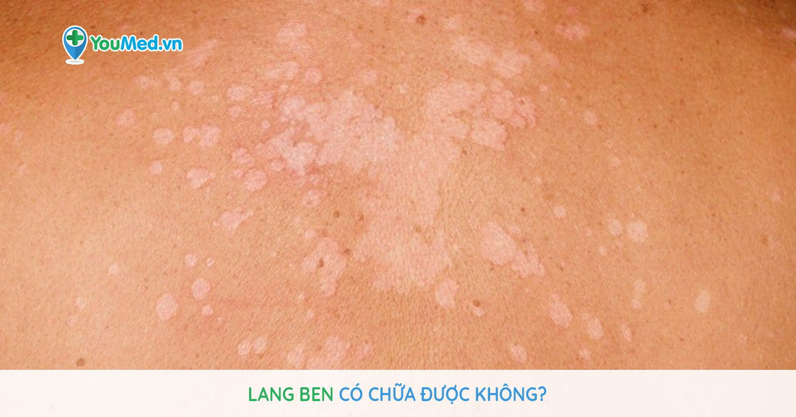 Lang Ben là gì? Bệnh Lang Ben có chữa được hay không?