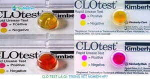 Clo test là gì trong xét nghiệm HP?