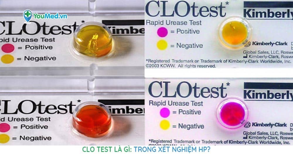 Clo test là gì: trong xét nghiệm HP