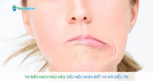 Tai biến mạch máu não: dấu hiệu nhận biết và nơi điều trị