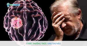 Y học thường thức: Ung thư Não