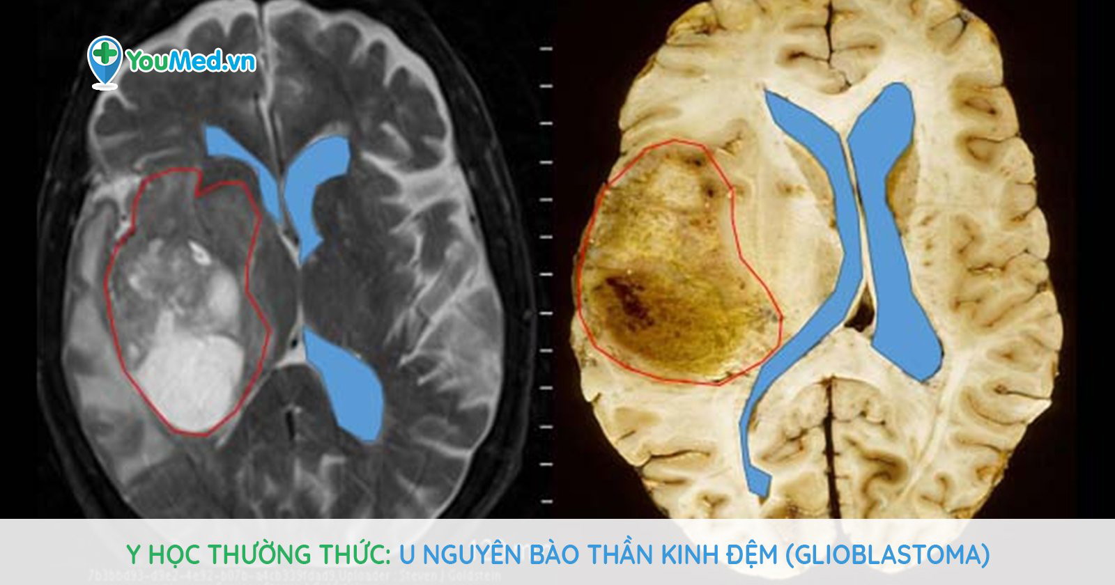 Chẩn đoán u nguyên bào thận