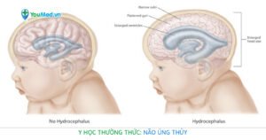 Y học thường thức: Não úng thủy