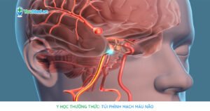 Y học thường thức: Túi phình mạch máu não