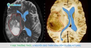 Y học thường thức: U nguyên bào thần kinh đệm (Glioblastoma)