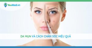 Da mụn và cách chăm sóc hiệu quả