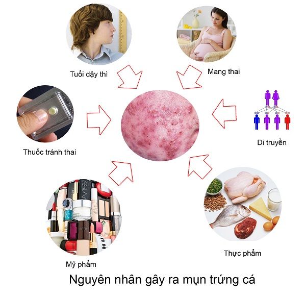 Các nguyên nhân khiến da bị mụn