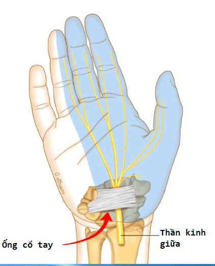 hội chứng ống cổ tay là gì