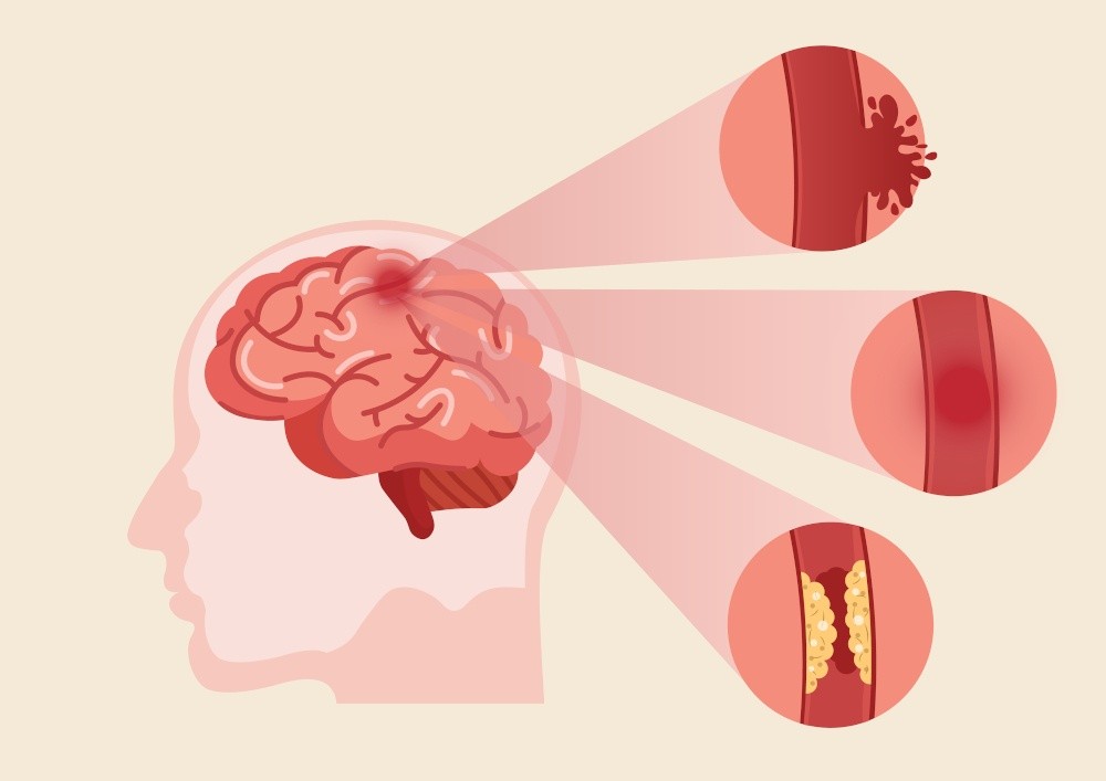 Đột quỵ do xuất huyết hay máu bị tắc nghẽn đều có thể dẫn đến sa sút trí tuệ não mạch