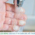 sơ cứu bỏng cách xử lý và chăm sóc vết thương