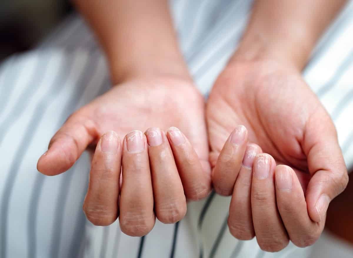 Thiếu máu có thể biểu hiện qua tình trạng móng tay