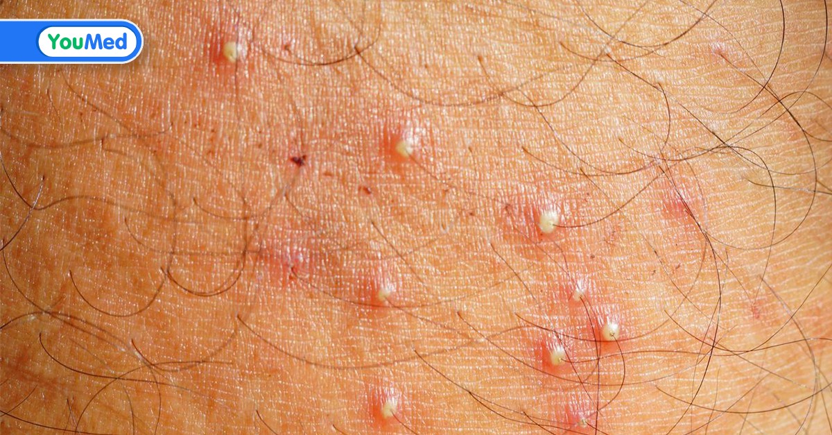Có những biến chứng gây ra bởi viêm nang lông không can thiệp sớm là gì?
