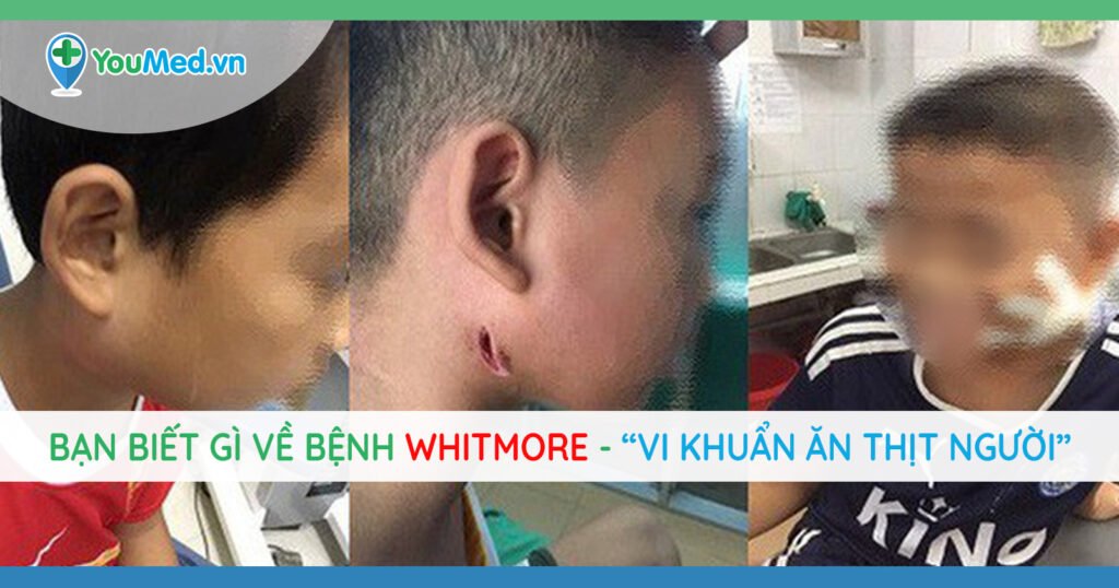 Bệnh Whitmore: Dấu hiệu, khả năng lây lan, mức độ nguy hiểm và phòng ngừa