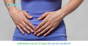 Xét nghiệm chẩn đoán u xơ – cơ tử cung