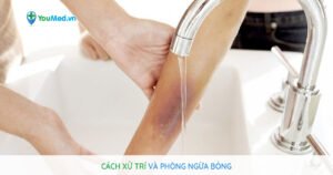 Cách xử lý vết bỏng và phòng ngừa