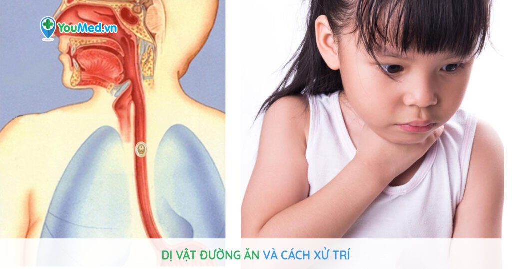 Dị vật đường ăn và cách xử trí