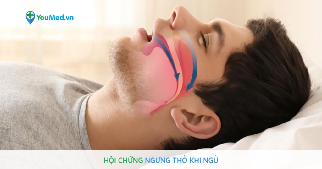 Hội chứng ngưng thở khi ngủ