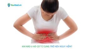 Khi nào bệnh u xơ cơ tử cung trở nên nguy hiểm?