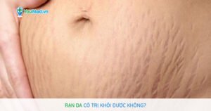 Rạn da có trị khỏi được không?