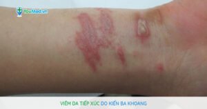 Viêm da tiếp xúc do kiến ba khoang