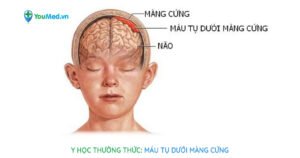 Y học thường thức: Máu tụ dưới màng cứng