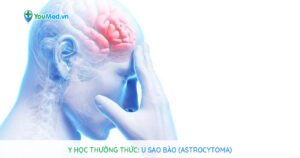 Y học thường thức: U sao bào (Astrocytoma)