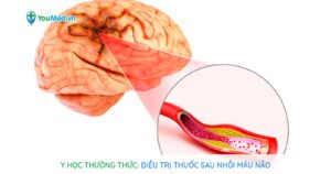 Y học thường thức: Điều trị thuốc sau nhồi máu não