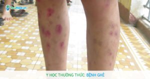 Y học thường thức: Bệnh Ghẻ