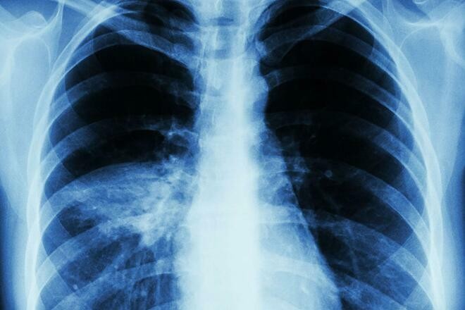 Thủy đậu có thể dẫn đến các biến chứng như: viêm phổi, bội nhiễm, viêm não,...