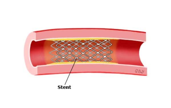 Stent có thể dùng ở rất nhiều mạch máu khác nhau