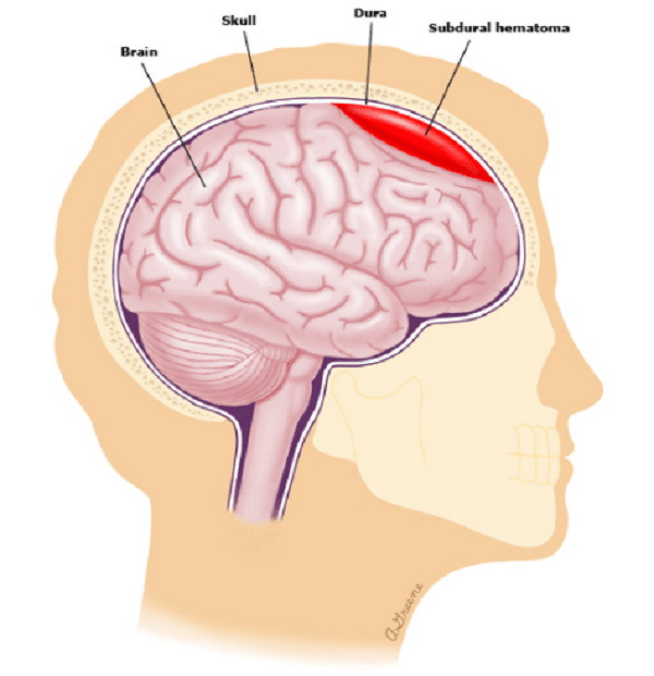 Subdural hematoma: máu tụ dưới màng cứng