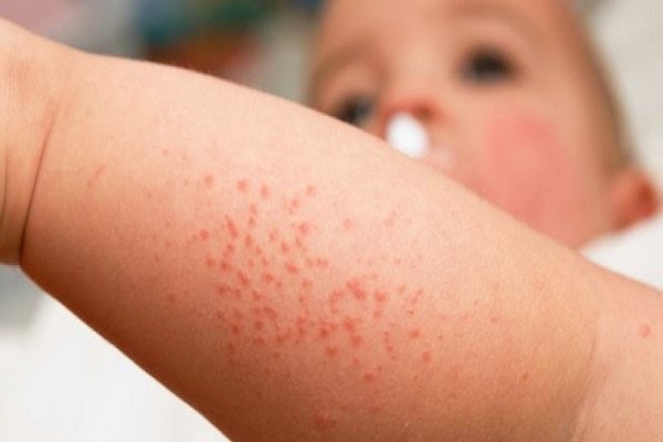Chấm xuất huyết là một trong những dấu hiệu bệnh sốt xuất huyết
