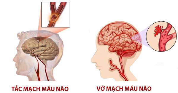 tai biến mạch máu não