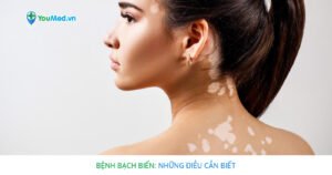 Bệnh bạch biến: Phương pháp phòng ngừa và điều trị bệnh