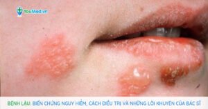 Bệnh lậu: Biến chứng nguy hiểm, cách điều trị và lời khuyên của bác sĩ